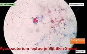 Slit Skin Smear Adalah